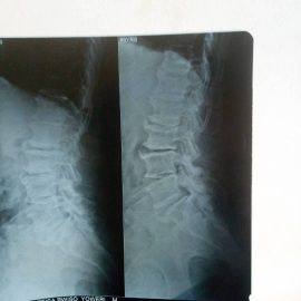 Degenerative Disorders4