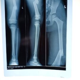 External fixation in open fractures tibia and fibula1