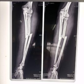 Trauma forearm  surgery plating