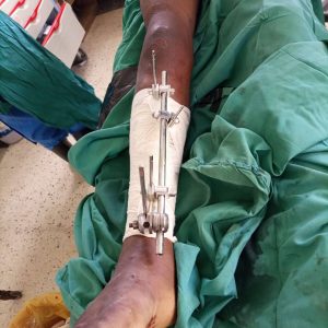 External fixation in open fractures tibia and fibula