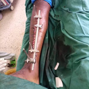 External fixation in open fractures tibia and fibula