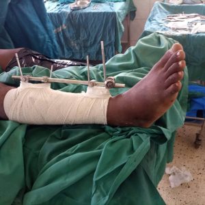 External fixation in open fractures tibia and fibula