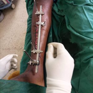 External fixation in open fractures tibia and fibula