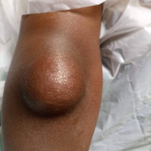 Olecranon bursitis