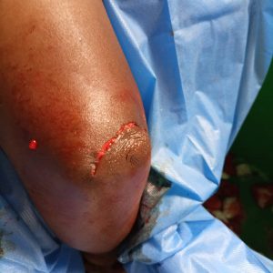 Olecranon bursitis