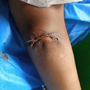 Olecranon bursitis
