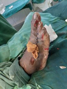 Healed foot