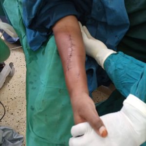 Trauma forearm  surgery plating